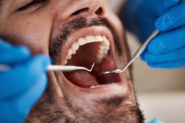 Best Emergency Dental Care for Abscessed Tooth in East Douglas, MA